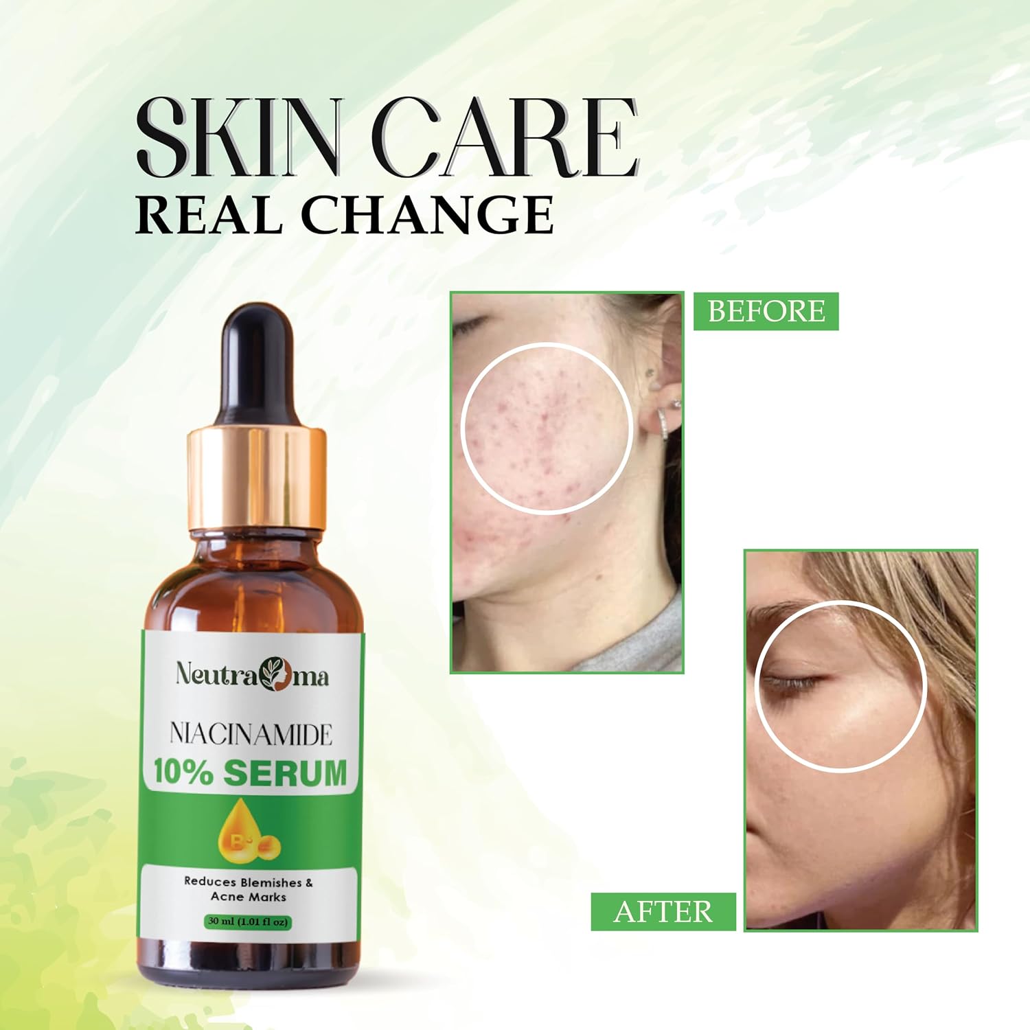 Niacinamide 10% Serum for Dark Spots, Acne Marks & Uneven Skin Tone | Vitamin B3 Brightening Face Serum | Oil Control, Pore Minimizer | 30ml Paraben-Free, Unscented